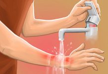 प्राथमिक उपचार स् पोलेका बिरामीको हेरचाह कसरी गर्ने